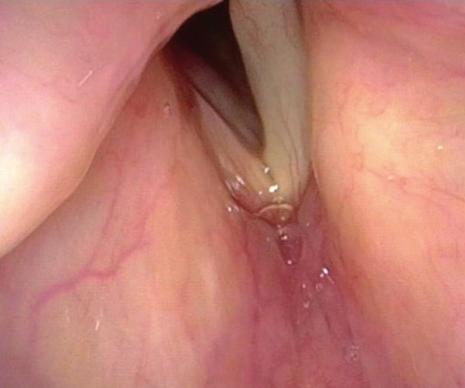 3, 4) využití laserů (CO 2, thuliový a další) intubace užšími kanylami v porovnání se standardem využití tryskové ventilace u akutních lézí kortikoidy celkově, inhibitory protonové pumpy, ATB