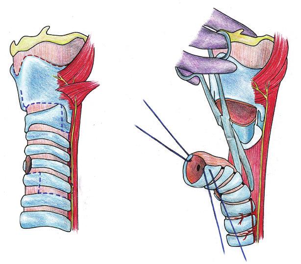 Obr. 11: Schéma laryngotracheální rekonstrukce chrupavkou ze žebra Obr.