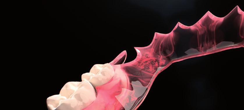 ústech působí velmi přirozeně a je prakticky nezničitelná. Zároveň dokážeme menším laboratořím nabídnout řešení, jak se obejít bez nákladných CAD/CAM zařízení.