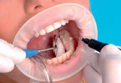 dentinu poskytuje vyšší vazebnou sílu, která zajistí vysokou spolehlivost a pevnost vazby. Nanoplnivo je stabilní a nesedimentuje - odpadá nutnost před použitím protřepat.