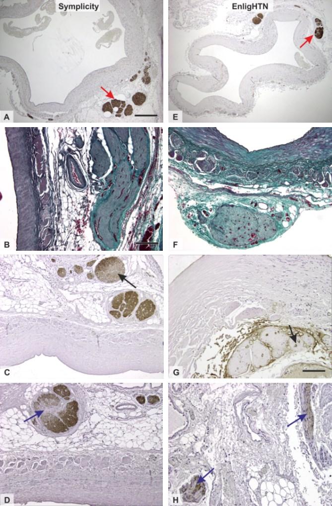 Obr. 8. Příklady histologických nálezů poškozených nervů u obou skupin zvířat po ablaci katetrem Symplicity Flex (vlevo) a EnligHTN (vpravo) [30].