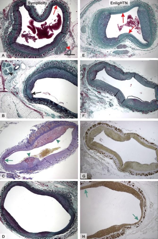 Obr. 9. Příklady histologických nálezů cévního poškození u obou skupin zvířat po ablaci s použitím katetru Symplicity Flex (vlevo) a EnligHTN katetru (vpravo) [30].