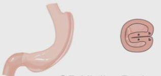gastrectomy