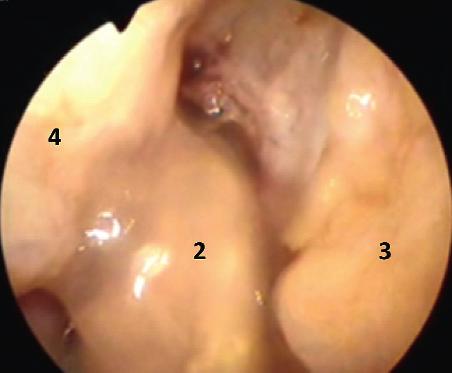 femorálního kanálu. Oblast původního tibiálního a femorálního úponu byla zbavena zbytků nativního LCA, aby bylo možné označit centra původního úponu na femuru a tibii.