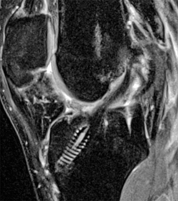 347/ Acta Chir Orthop Traumatol Cech. 85, 2018, No. 5 PŮVODNÍ PRÁCE Příklady MRI nálezů různých pacientů zařazených do skupiny 1 tzn. s aplikací PRF (viz obr. 4 