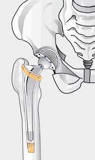 Různé možnosti implantace 1 2 1 1 3 Schéma necementované