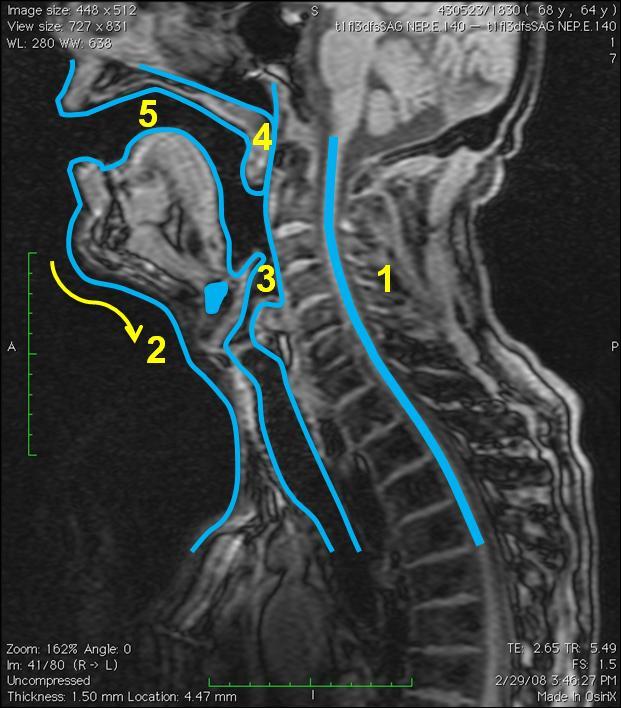 5.1.2 Vokál [e:] Obrázek 24 MRI subjektu 1, vokál *e:+, vlevo nepěvecky, vpravo pěvecky - subjekt 1 je zachycen jak při technice neoperní, tak operní.