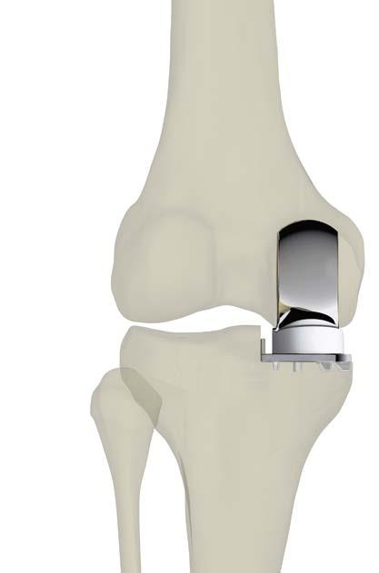 1 Jednostranná náhrada povrchu 2 3 1 Jednostranný implantát na