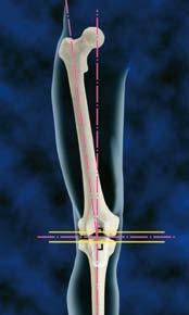 2. Jaké výhody přináší navigační systém OrthoPilot?
