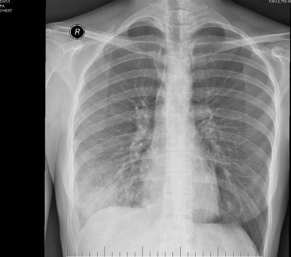 o Škálování závažnosti pneumonií - systém CURB-65 Za každý příznak jeden bod C - confusion nově vzniklá