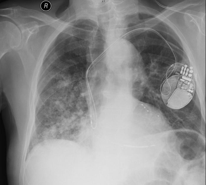 o K diagnostice pneumonie je třeba 1) Nález čerstvých plicních infiltrátů na skiagramu hrudníku nebo na CT 2) Alespoň dva příznaky infektu dolních