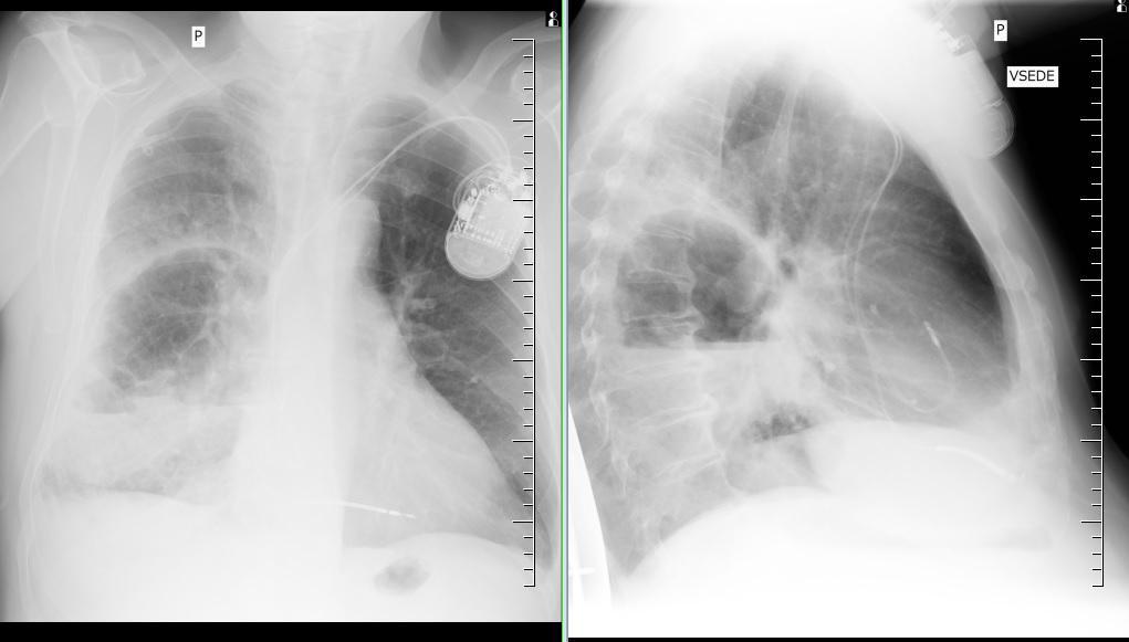 o Komplikace pneumonie tvorba abscesu tj.