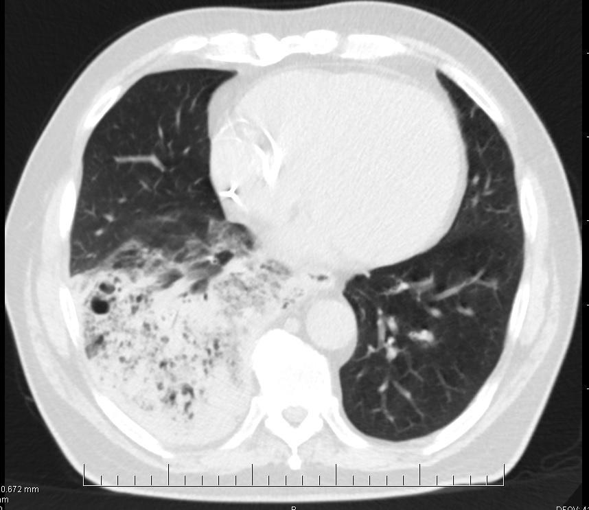 o Komplikace pneumonie tvorba abscesu tj.