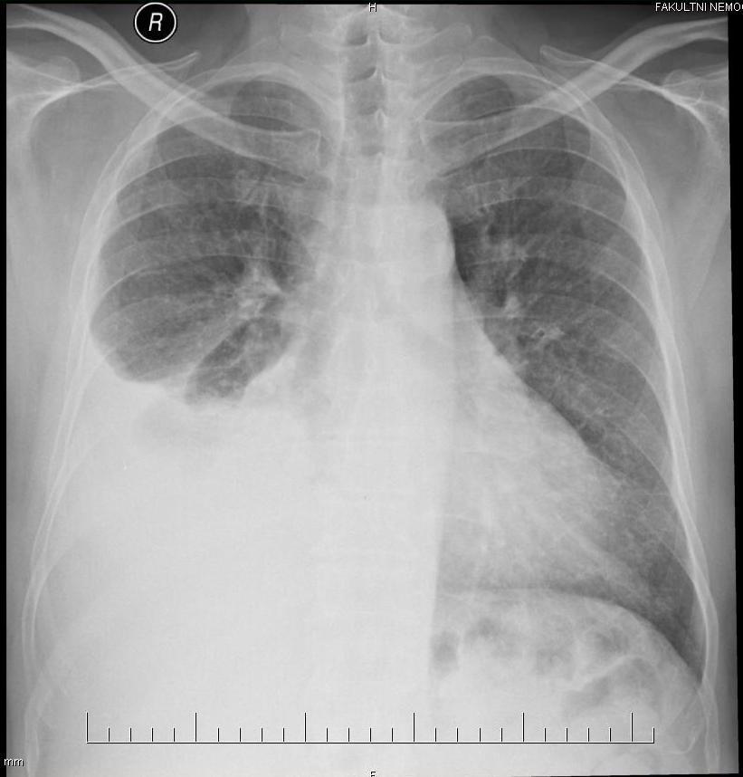 o Komplikace pneumonie tvorba pleurálního výpotku je