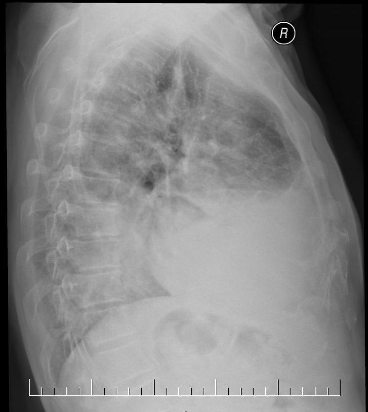 pleuropneumonie Vzniká, je-li zánět lokalizován blízko