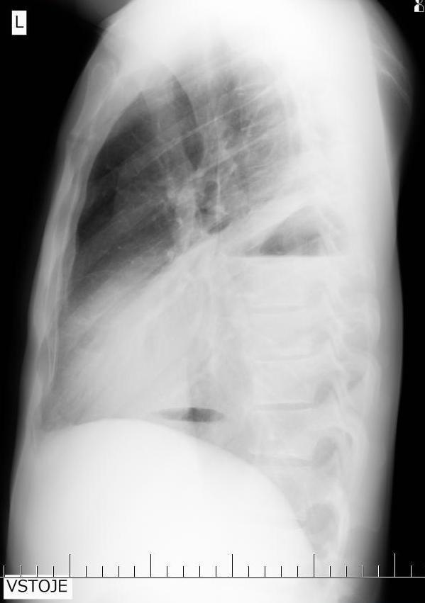 o Komplikace pneumonie tvorba empyému hnisavého pleurálního výpotku při neléčené pneumonii s