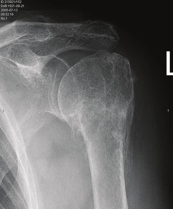 -B 1.1. (číslování obrázků, tabulek i grafů odpovídá dizertační práci) Dlahy Cílem vnitřní osteosyntézy je anatomická repozice a stabilní fixace, která dovolí co nejčasnější rehabilitaci viz.