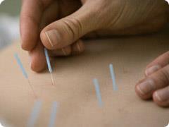 Příloha 4 Obrázek akupunktury a akupresury Při akupunktuře vpichuje porodní