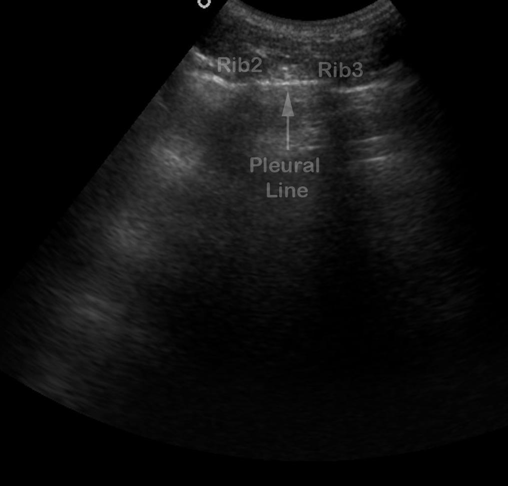 Sonografie hrudníku Nejčastější echokardiografie srdce (ostatní části hrudníku při ní ale systematicky prohlíženy nejsou) Sonografie pleurálního prostoru zaměření a odhad velikosti
