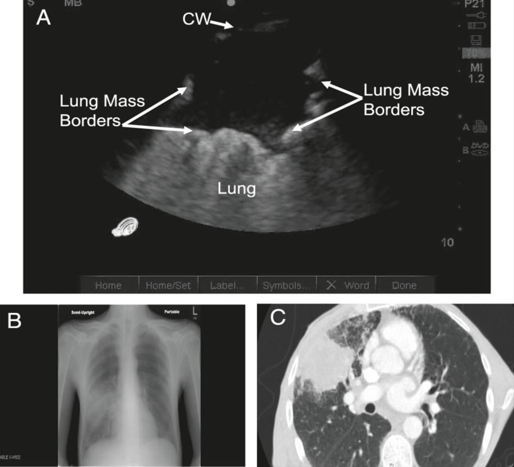 Sonografie hrudníku Nejčastější echokardiografie srdce (ostatní části hrudníku při ní ale systematicky prohlíženy nejsou) Sonografie pleurálního prostoru zaměření a odhad velikosti pleurálního