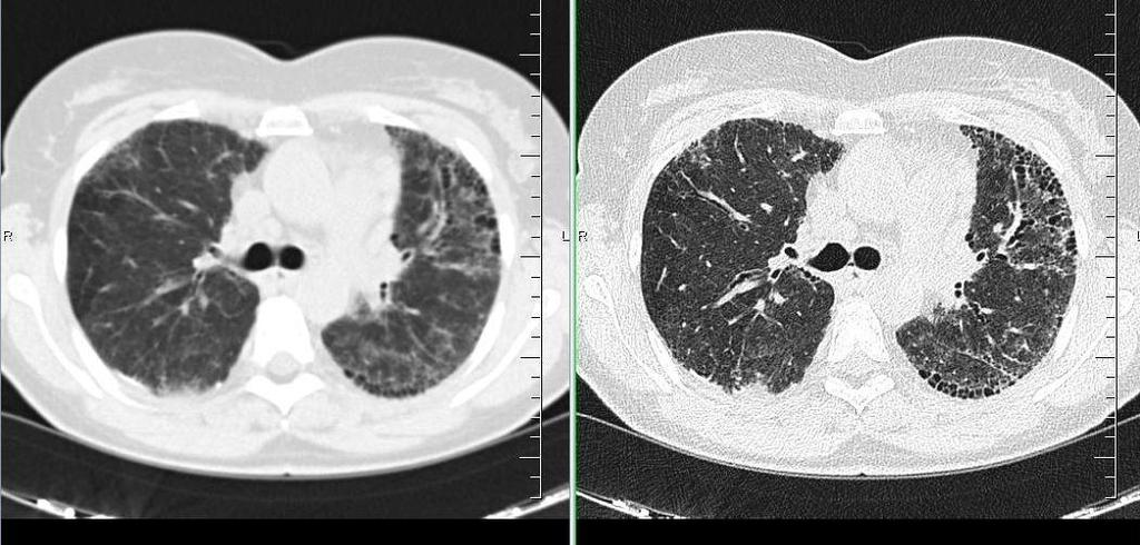 CT hrudníku CT hrudníku (5mm síla řezů) + Je možnost vyšetření kontrastní látkou + Vyšetření je spojitější (méně přeskočených oblastí mezi scany