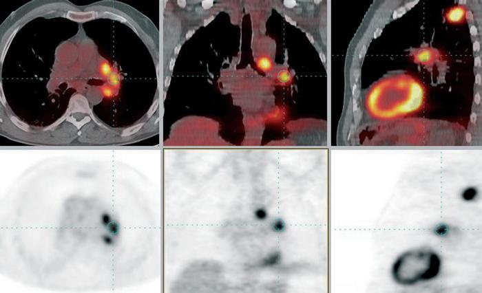 Fúzní PET/CT