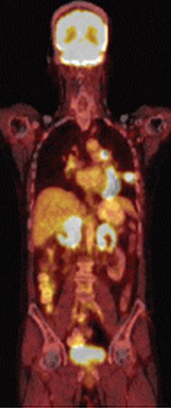 Pozitronová emisní tomografie PET/CT trupu Mozek má intenzivní metabolismus glukózy, proto je omezeně hodnotitelný Na
