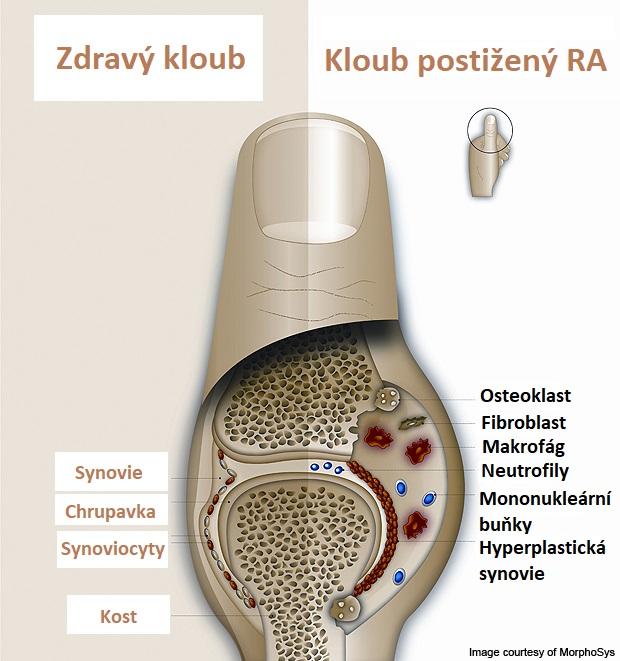 V synovii se mohou tvořit folikuly tvořené B a T lymfocyty a folikulárními dendritickými buňkami.