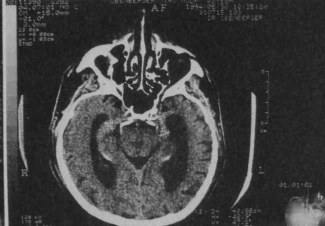 Obr. 7 CT - axiální řez mozkem; proměření mediálních spánkových struktur u pokročilé AD (vlevo) a normální nález (vpravo) [5, 20] 2.4.3.