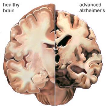 Obr. 16 Porovnání mezi zdravou mozkovou kůrou (vlevo) a poškozenou AD (vpravo) [73] 4.2 Histopatogeneze (mikroskopické změny mozku) Mikroskopické změny v mozku u pacientů s AD se vyznačují tím, že: 1.