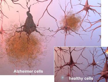 Obr. 17 Obrázek poukazuje na rozdíl mezi zdravými nervovými buňkami (vpravo) a poškozenými AD (vlevo) [73]. Obr. 18 Vznik senilních plaků a neuronálních klubek.