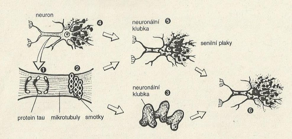 U čísla 3 vznikají neuronální klubka narušující funkci nervové buňky a u čísla 4 můžeme sledovat nerozpustná depozita Aβ, která se mění na senilní plaků.
