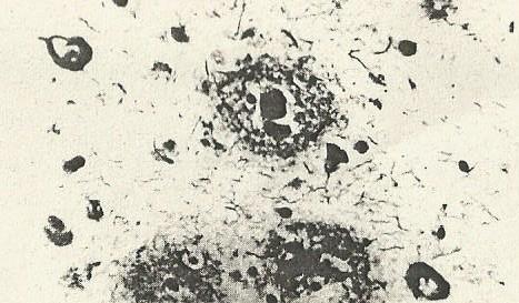 4.2.1 Senilní plaky Senilní plaky (obr. 19) v histologických řezech můžeme vidět jako nepravidelně okrouhlé, heterogenní útvary velké asi 10-200 µm, které obsahují amyloid.