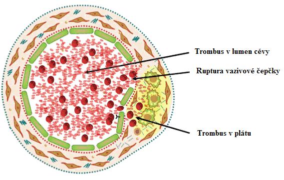 Během opravného procesu se uvolňuje TGF-β, který stimuluje VSCMs, díky nimž se může vytvořit nezbytná tkáň a extracelulární matrix pro tvorbu kostry vazivové čepičky.