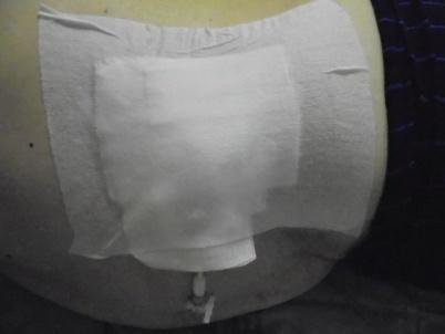 Obrázek 7: Vrchní krytí nefrostomického katetru Zdroj: vlastní 8.