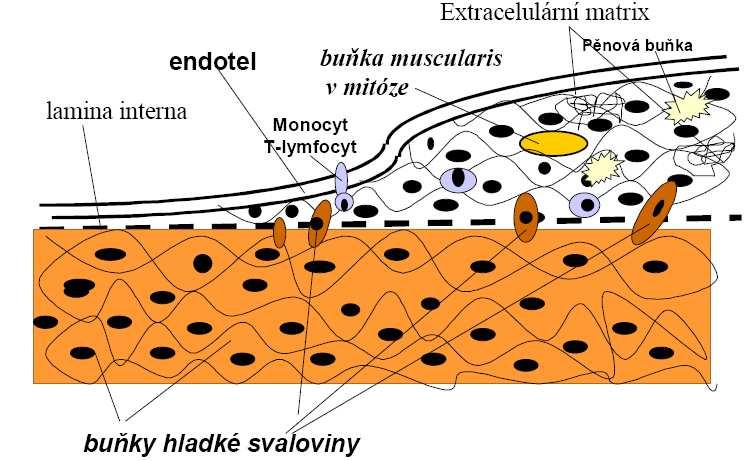 3 Obrázek: Schéma ztlušťování stěny artérie v průběhu aterogeneze (převzato z internetových stránek: http://www.freewebs.com/stefajir/atero.