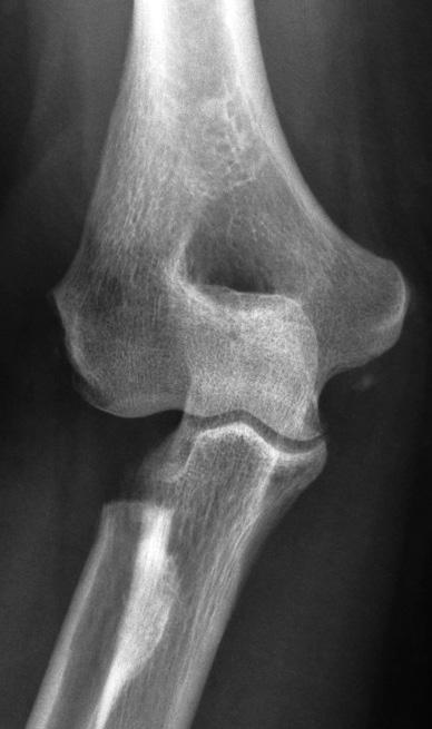 U všech pacientů bylo provedeno rentgenové vyšetření lokte ve dvou projekcích. Rentgenové vyšetření celého předloktí včetně zápěstí bylo provedeno pouze při klinicky patrné nestabilitě zápěstí.