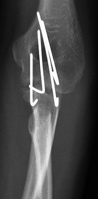 Parestezie horní končetiny odezněly, pacient však v odstupu čtyř roků od operace stále trpěl klidovými bolestmi nohy v místě po odběru štěpu nervu.