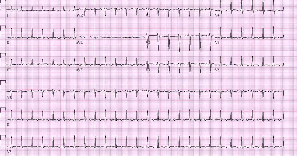 Proč EKG?