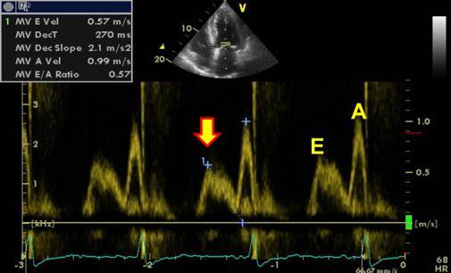 Diastolická dysfunkce echo hodnocení