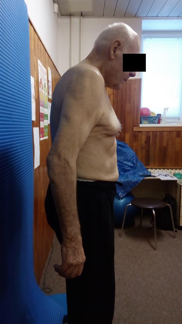5.2 KINEZIOLOGICKÝ ROZBOR Z důvodu určitého sociálního diskomfortu kvůli nošení plen pacient odmítl odložit teplákové kalhoty.
