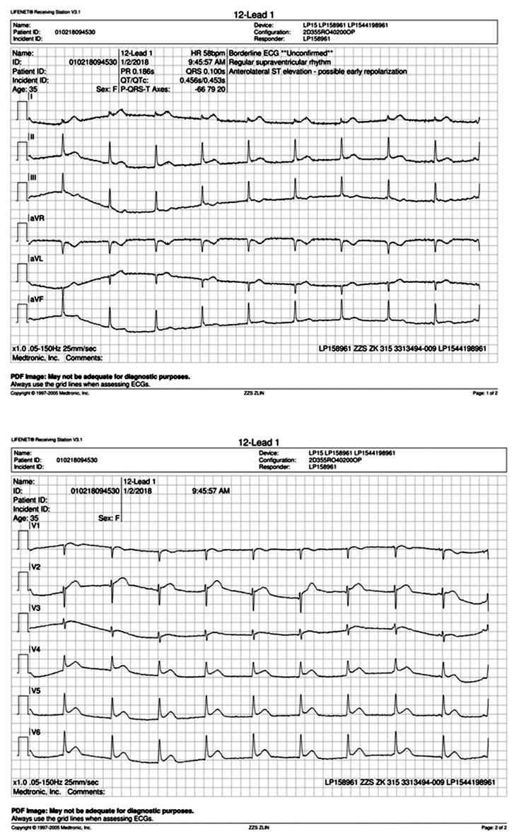 Obr. 1. 12svodové EKG pořízené posádkou ZZS Obr. 2. Angiografický nález při diagnostickém nástřiku ACS Obr. 3. Angiografický nález při diagnostickém nástřiku ACD Obr. 4.