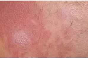 způsobuje ztluštění epidermis, což vede k vyšší odolnosti vůči dalšímu ozáření.