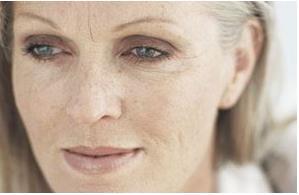 3.2.1 Stárnutí kůže (photoaging) U stárnutí kůže způsobeném UV zářením dochází k hrubým i mikroskopickým kožním změnám. Jako photoaging neoznačujeme urychlení stárnutí závislé na věku.