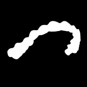 Průhledná rovnátka Invisalign First mohou pomoci při: Vývoji oblouku Rozšíření oblouku Vytvoření prostoru při