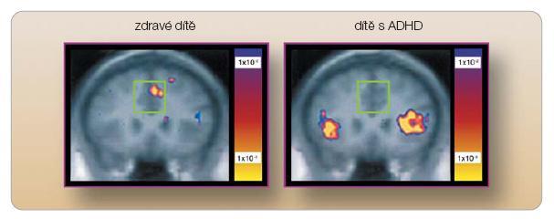 Dle Biedermana (2005; in Malá, 2007) je celosvětová prevalence ADHD udávána v rozmezí 3 9 %.