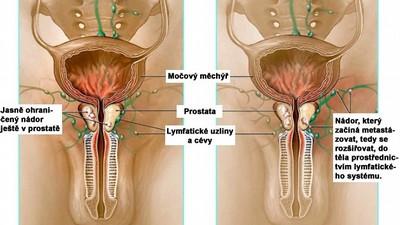 Nákres rakovinného nádoru prostaty FOTO: archiv Novinky.