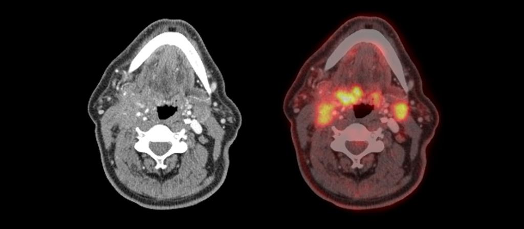 DIAGNOSTIKA Obrázek č. 1: FDG-PET/CT karcinom orofaryngu T4N2M0 (TNM, 8. vydání) Zdroj: Archiv autorky Obrázek č. 2: Karcinom nosohltanu T2N1M0 (TNM, 8.