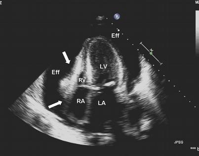 Echokardiografie Při čekání na připravení kardiochirurgického sálu -Provedeno ECHO srdce kardiochirurgem i kardiologem -Zajištěna VJI