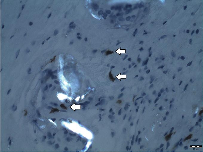 0x. Obr. 2. Cytoplazmatická a membránová pozitivita CD117 v mastocytech (hnědé zbarvení, šipky) a obrovské světélkující polyetylenové částice. Pacient č. 5, CD117, polarizace 400x. Obr. 3.